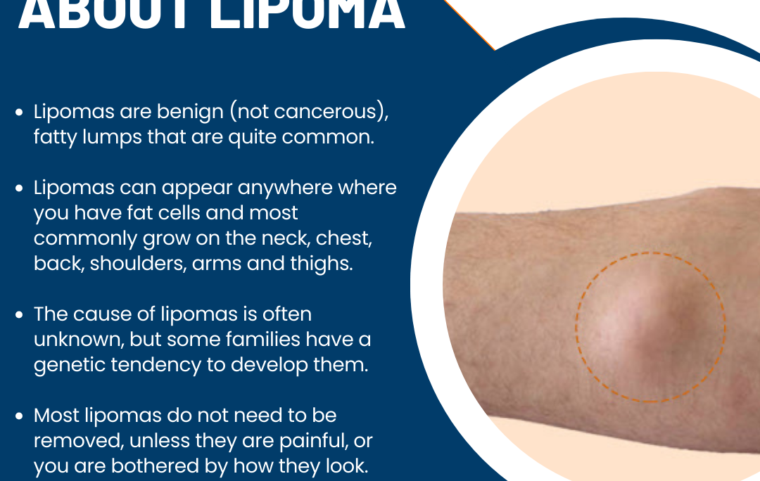 KEY FACTS ABOUT LIPOMA