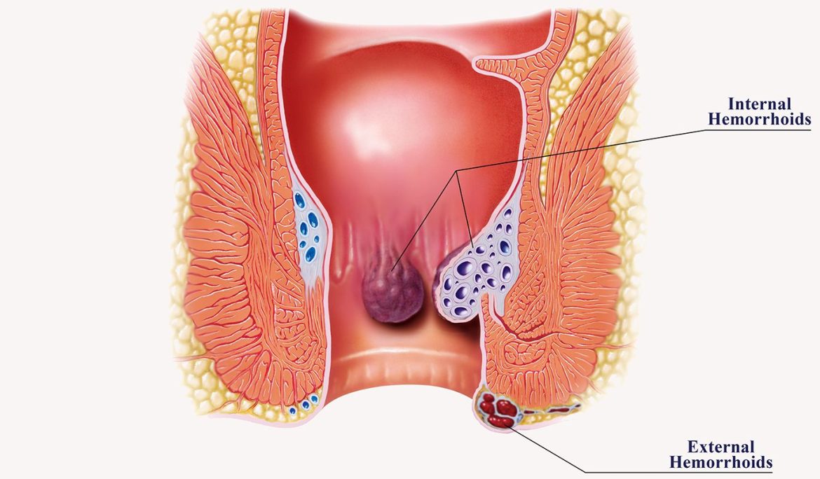 what-are-hemorrhoids-causes-symptoms-treatment-prevention-1440x810