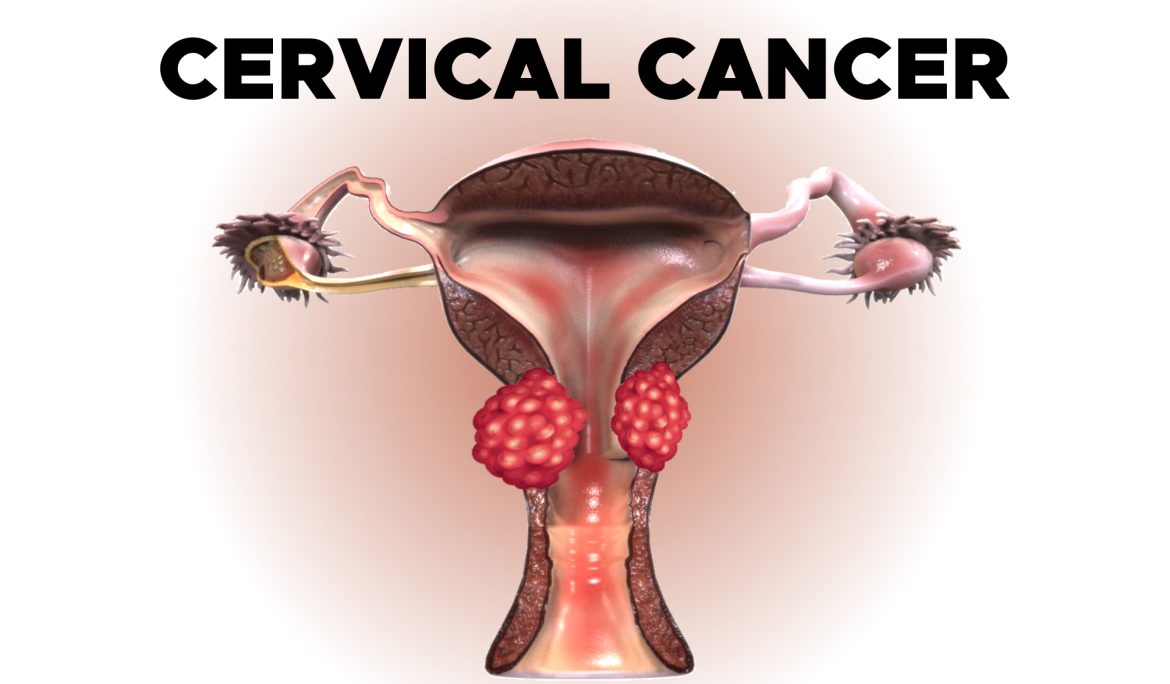 cervical-cancer