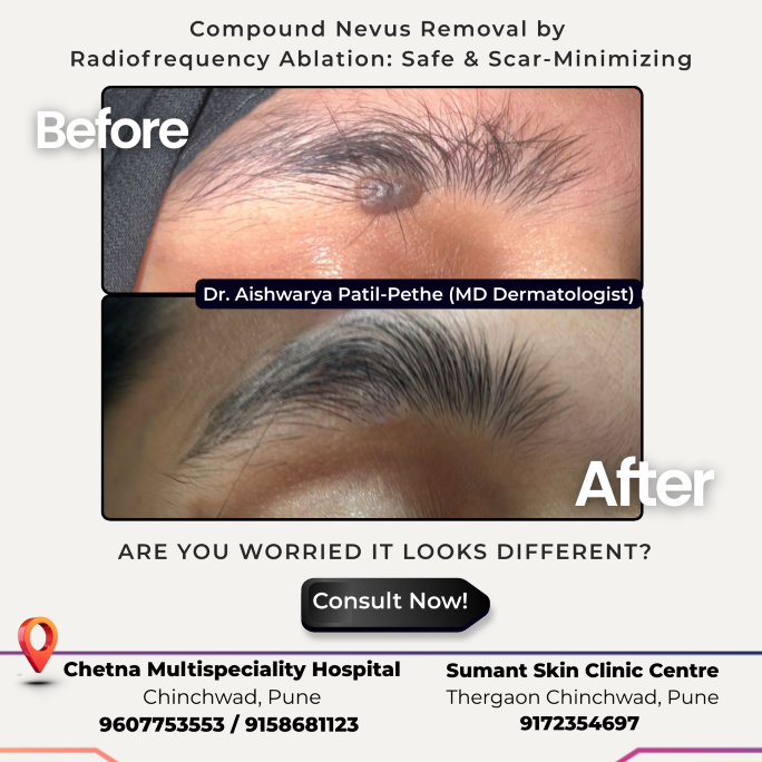 Compound Nevus Treatment By Dr. Aishwarya Patil PCMC."