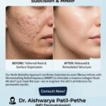 Best Acne Scar Treatment in Chinchwad by Dr. Aishwarya Patil