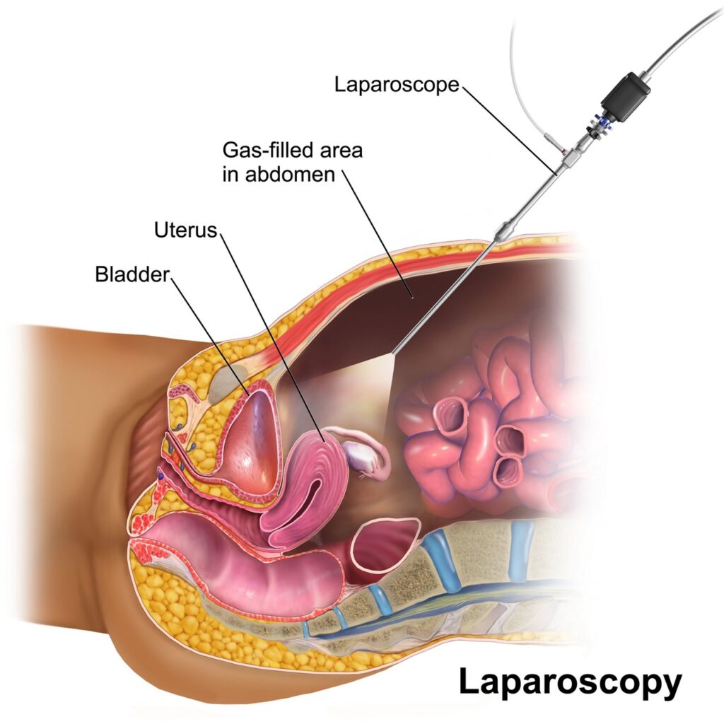 Illustration of laparoscopy showing a laparoscope inserted into a gas-filled abdominal cavity to view internal organs, including the uterus and bladder, demonstrating a minimally invasive procedure by a Laparoscopic Surgeon in Chinchwad.