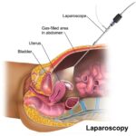 Illustration of laparoscopy showing a laparoscope inserted into a gas-filled abdominal cavity to view internal organs, including the uterus and bladder, demonstrating a minimally invasive procedure by a Laparoscopic Surgeon in Chinchwad.