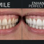 Teeth Whitening Teeth Whitening Procedure NextGen Dental Chinchwad Pune