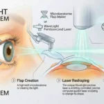 Dr. Rachana Tiwari Patil performing WaveLight Eye Surgery at Chetna Hospital Chinchwad Pune