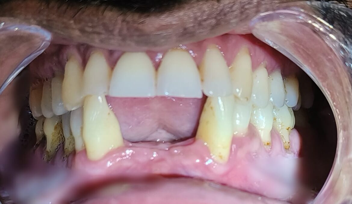 NextGen Dental Chinchwad - Emergency Front Tooth Loss Treatment