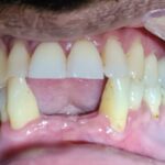Front tooth loss causes and symptoms in dental health