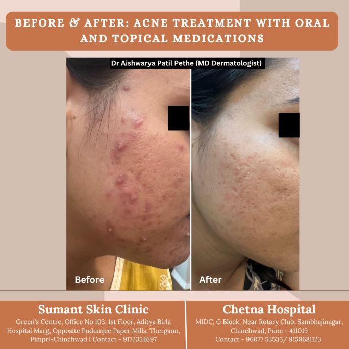 Dr Aishwarya Patil providing dermatologist for acne treatment in Pune