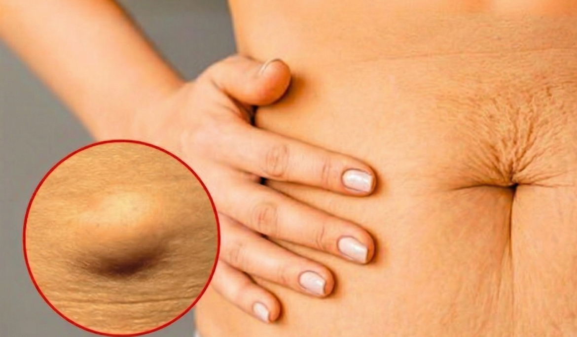 Lipoma surgery in Chinchwad Pune by Dr. Dhananjay Patil at Chetna Hospital