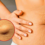 Lipoma treatment options including surgical and non-surgical removal of fatty lump