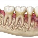of periodontal gum disease from healthy gums to advanced periodontitis.